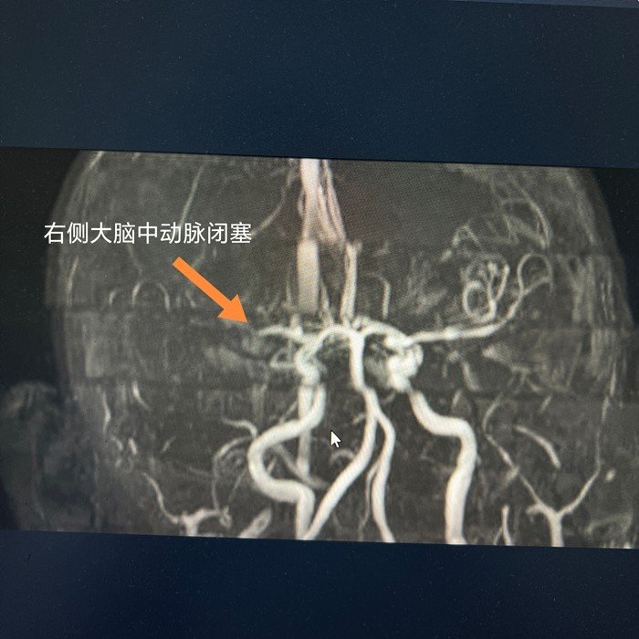 成功救治一名突发大面积脑梗死的游客