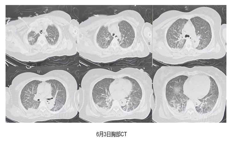 55岁的陈先生因“咳嗽伴喘憋4天